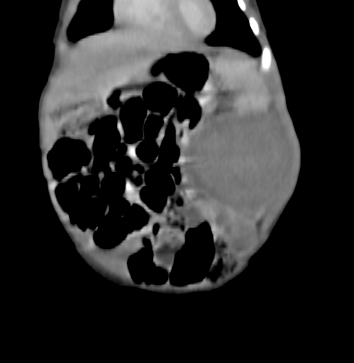 Nephroblastomatosis (Radiopaedia 71294-81607 B 92).jpg
