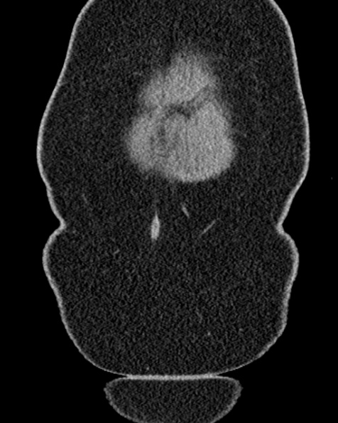 File:Nephrostomy for urosepsis (Radiopaedia 26180-26330 non-contrast 8).jpg