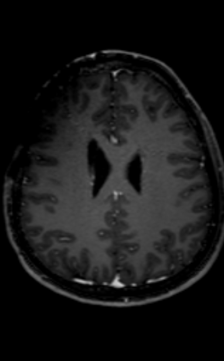 Neuro-Behçet disease (Radiopaedia 90112-107294 Axial T1 C+ 101).jpg