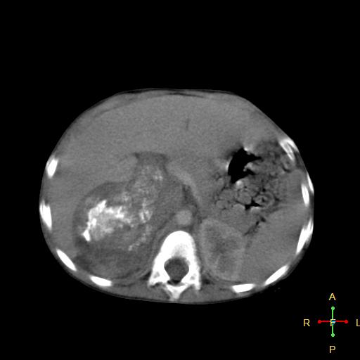 File:Neuroblastoma (Radiopaedia 24751-25016 D 12).jpg