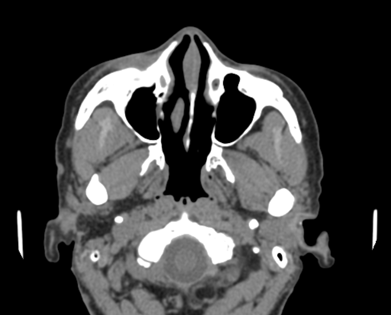 Neurofibromatosis type 1- orbital manifestations (Radiopaedia 49391-54511 Axial non-contrast 29).jpg