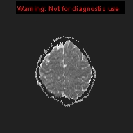 File:Neurofibromatosis type 1 with optic nerve glioma (Radiopaedia 16288-15965 Axial ADC 4).jpg