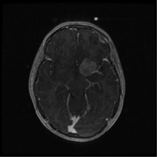 Neurofibromatosis type 2 (Radiopaedia 45229-49244 Axial T1 C+ 56).png