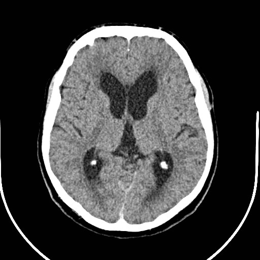 Neurofibromatosis type 2 (Radiopaedia 79097-92047 Axial non-contrast 31).jpg