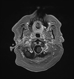 Neurofibromatosis type 2 (Radiopaedia 79097-92049 Axial T1 C+ 27).jpg