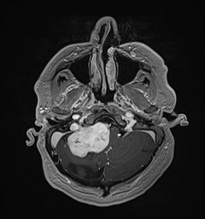 Neurofibromatosis type 2 (Radiopaedia 79097-92049 Axial T1 C+ 45).jpg