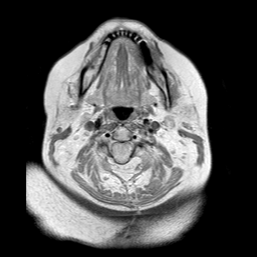 File:Neurofibromatosis type 2 (Radiopaedia 8713-9518 Axial Gradient Echo 28).jpg