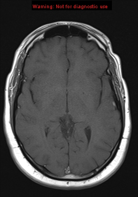 File:Neuroglial cyst (Radiopaedia 10713-11184 Axial T1 12).jpg