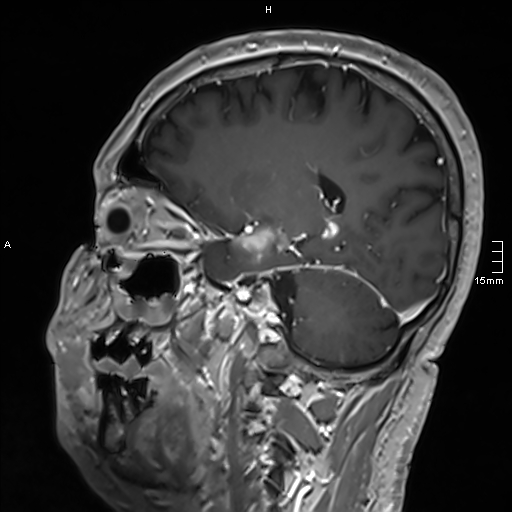 Neurosarcoidosis - involvement of the mesial temporal lobes (Radiopaedia 67429-76820 Sagittal T1 C+ 107).jpg