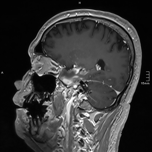 Neurosarcoidosis - involvement of the mesial temporal lobes (Radiopaedia 67429-76820 Sagittal T1 C+ 60).jpg