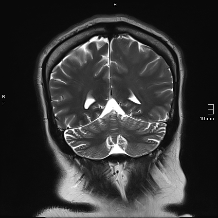 File:Neurotoxoplasmosis - concentric target sign (Radiopaedia 70644-80784 Coronal T2 15).jpg