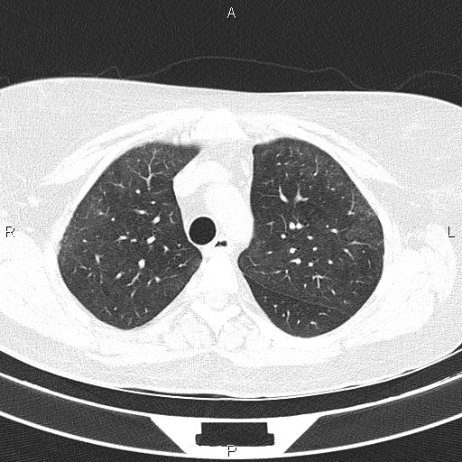 Non-specific interstitial pneumonia (Radiopaedia 83185-97567 Axial lung window 21).jpg