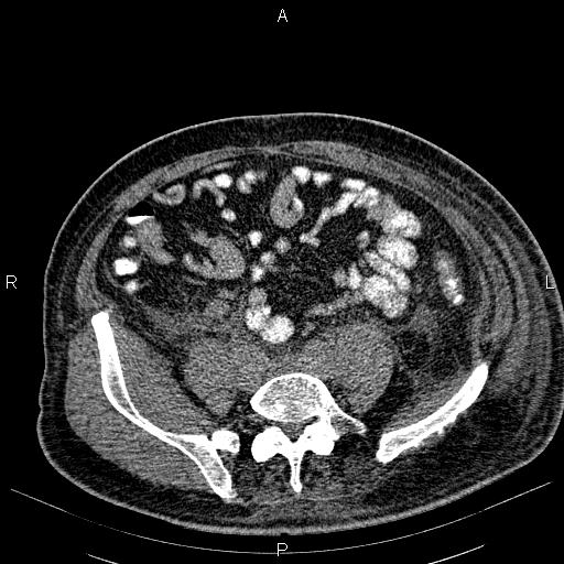 File:Non Hodgkin lymphoma in a patient with ankylosing spondylitis (Radiopaedia 84323-99621 Axial non-contrast 47).jpg