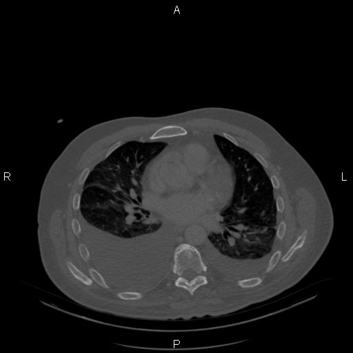Non Hodgkin lymphoma in a patient with ankylosing spondylitis (Radiopaedia 84323-99624 Axial bone window 16).jpg