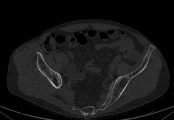 File:Nondisplaced incomplete intertrochanteric fracture (Radiopaedia 73736-84539 Axial bone window 3).jpg