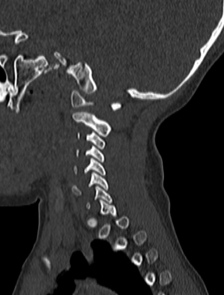File:Normal CT cervical spine - pediatric (Radiopaedia 52549-58462 Sagittal bone window 162).jpg