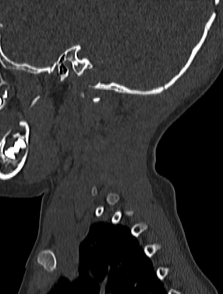 File:Normal CT cervical spine - pediatric (Radiopaedia 52549-58462 Sagittal bone window 5).jpg