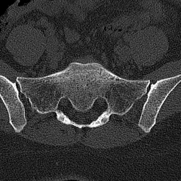 File:Normal CT lumbar spine (Radiopaedia 53981-60118 Axial bone window 69).jpg
