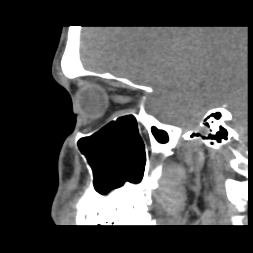 Normal CT paranasal sinuses (Radiopaedia 42286-45390 F 54).jpg