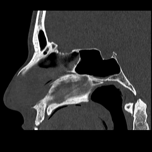 Normal CT paranasal sinuses (Radiopaedia 42286-45390 Sagittal bone window 52).jpg