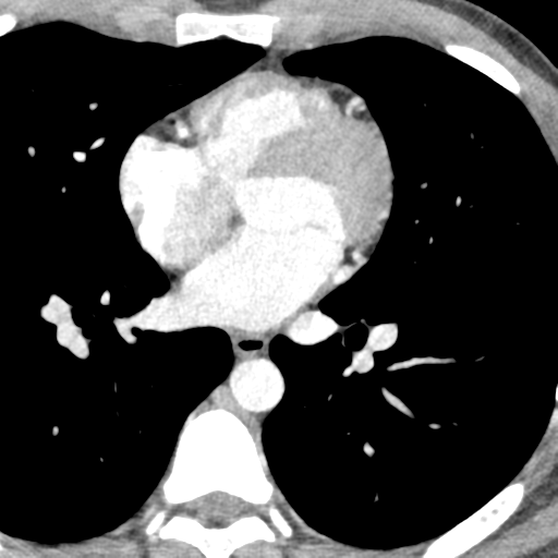 File:Normal CT pulmonary veins (pre RF ablation) (Radiopaedia 41748-44702 A 177).png
