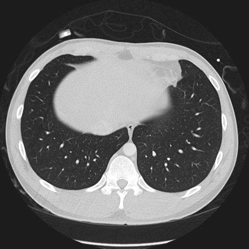 Normal CT pulmonary veins (pre RF ablation) (Radiopaedia 41748-44702 Axial lung window 53).png