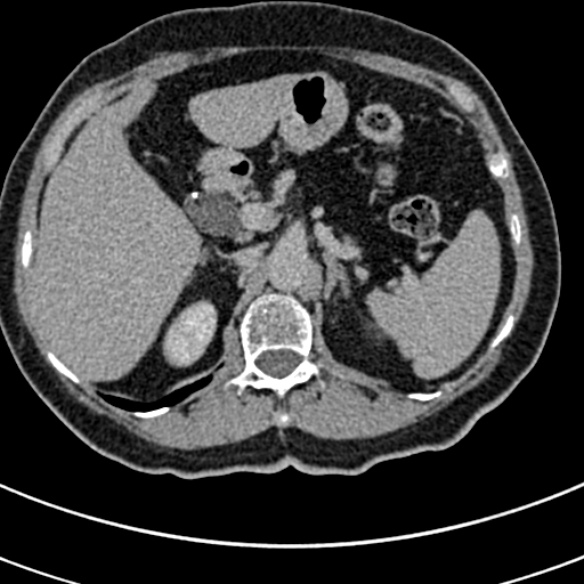 File:Normal CT split bolus study of the renal tract (Radiopaedia 48631-53634 Axial split bolus 26).jpg