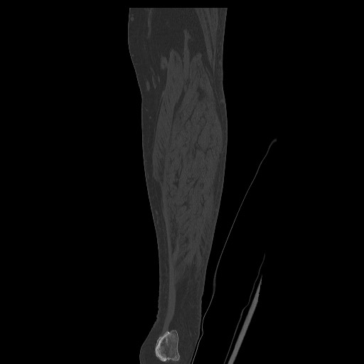 Normal CT tibia and fibula (Radiopaedia 51195-56848 Coronal non-contrast 54).jpg