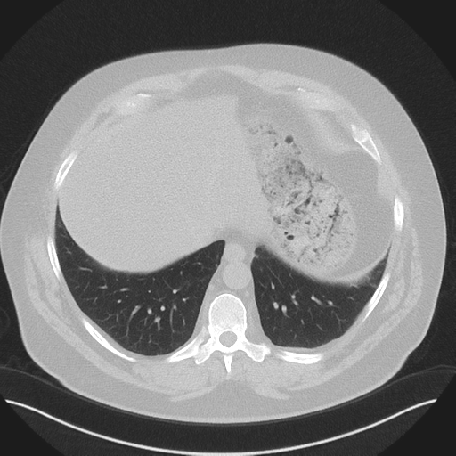 Normal HRCT (Radiopaedia 40797-43458 Axial lung window 46).png