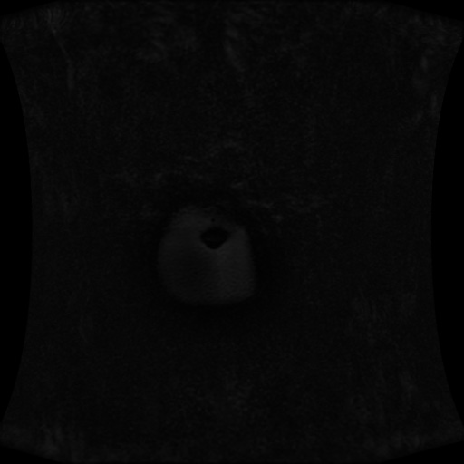 Normal MRI abdomen in pregnancy (Radiopaedia 88001-104541 M 7).jpg