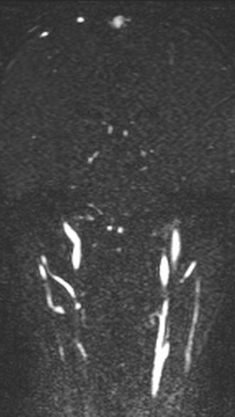 Normal MRI brain with MRV- teenager (Radiopaedia 49425-54553 Coronal MRV 145).jpg