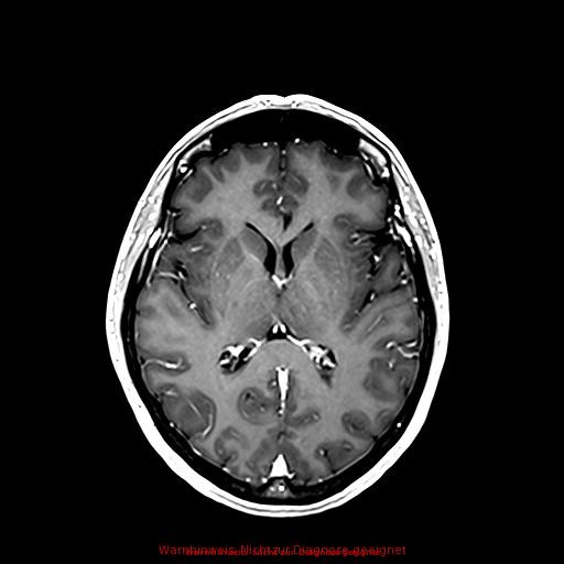 Normal adult brain MRI (non-enhanced and contrast-enhanced) (Radiopaedia 75262-86379 Axial T1 C+ 108).jpg