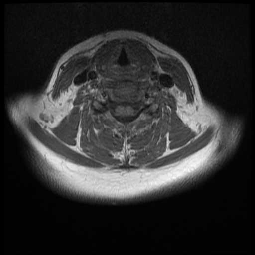 File:Normal cervical and thoracic spine MRI (Radiopaedia 35630-37156 Axial T1 16).png