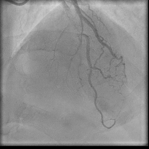 Normal coronary angiogram (DSA) (Radiopaedia 63081-71571 E 71).jpg