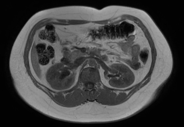 File:Normal liver MRI with Gadolinium (Radiopaedia 58913-66163 Axial T1 in-phase 14).jpg