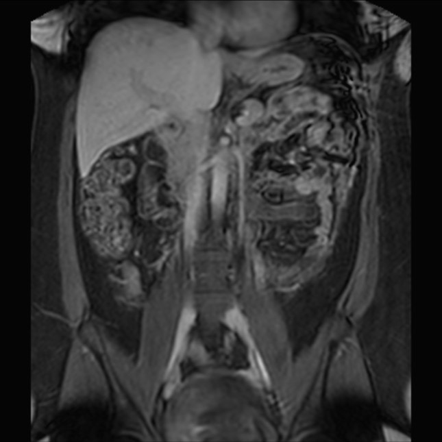 Normal liver MRI with Gadolinium (Radiopaedia 58913-66163 P 44).jpg