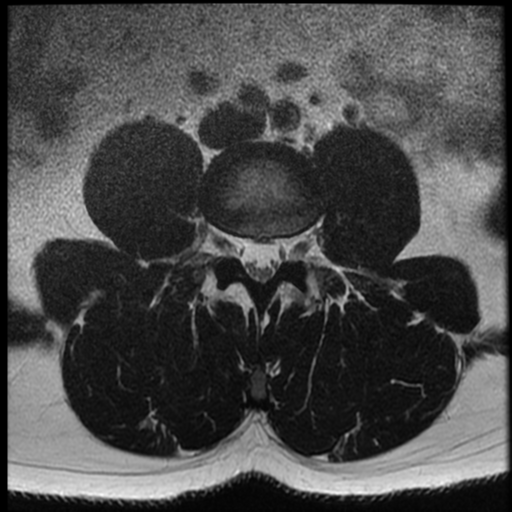 File:Normal lumbar spine MRI (Radiopaedia 35543-37039 Axial T2 22).png
