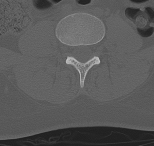 File:Normal lumbosacral CT (Radiopaedia 37923-39867 Axial bone window 65).png