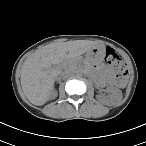 File:Normal multiphase CT liver (Radiopaedia 38026-39996 Axial non-contrast 28).jpg