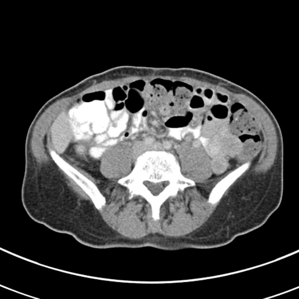 File:Normal multiphase CT liver (Radiopaedia 38026-39996 C 56).jpg