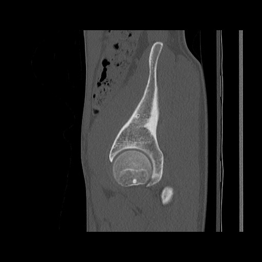 Normal pelvis (Radiopaedia 51473-57238 Sagittal bone window 37).jpg
