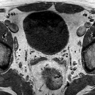 File:Normal prostate (MRI) (Radiopaedia 29986-30535 Axial T1 25).jpg
