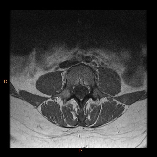 File:Normal spine MRI (Radiopaedia 77323-89408 Axial T1 11).jpg