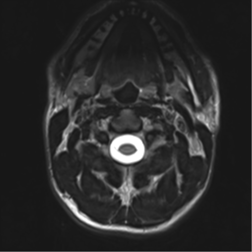 Normal trauma cervical spine (Radiopaedia 41017-43762 D 4).png