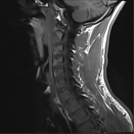 File:Normal trauma cervical spine (Radiopaedia 41017-43762 Sagittal T1 11).png