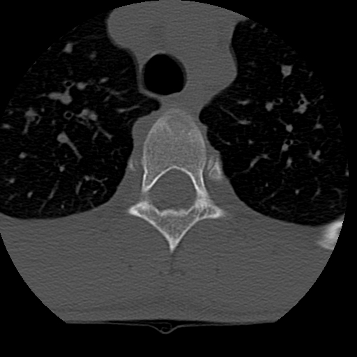 File:Normal trauma spine imaging (age 16) (Radiopaedia 45335-49358 Axial bone window 100).jpg
