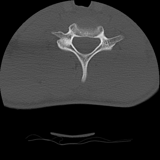 Normal trauma spine imaging (age 16) (Radiopaedia 45335-49358 Axial bone window 61).jpg
