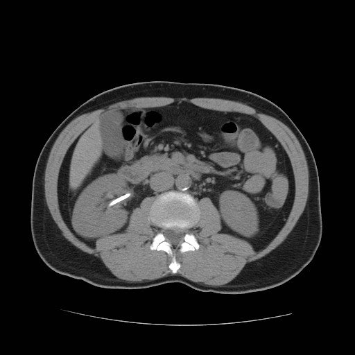 File:Obstructed kidney with perinephric urinoma (Radiopaedia 26889-27067 Axial non-contrast 14).jpg
