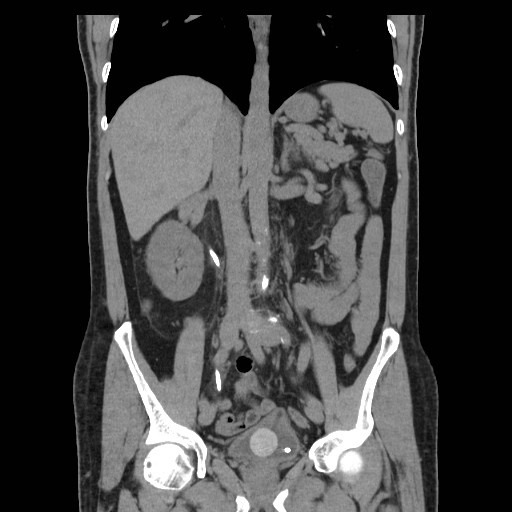 File:Obstructed kidney with perinephric urinoma (Radiopaedia 26889-27067 Coronal non-contrast 8).jpg