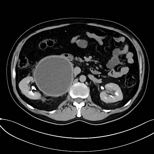 Obstructed upper pole ureter in a duplex kidney (Radiopaedia 54935-61221 Axial C+ delayed 21).jpg